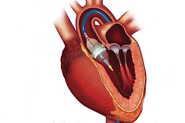 Transcatheter Interventions