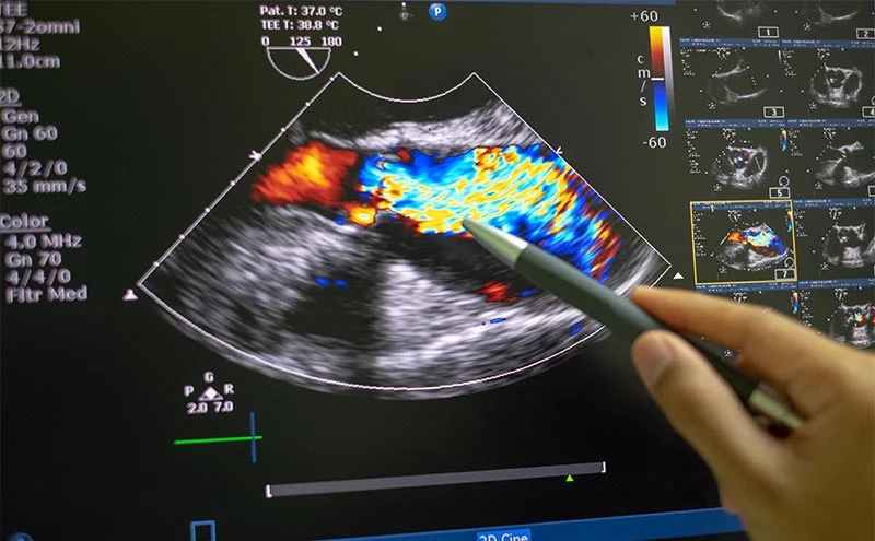 echocardiography